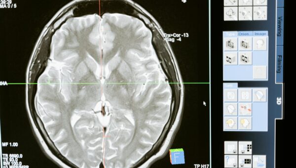 Science Corp’s Groundbreaking Brain Sensor Trial Set to Begin Soon